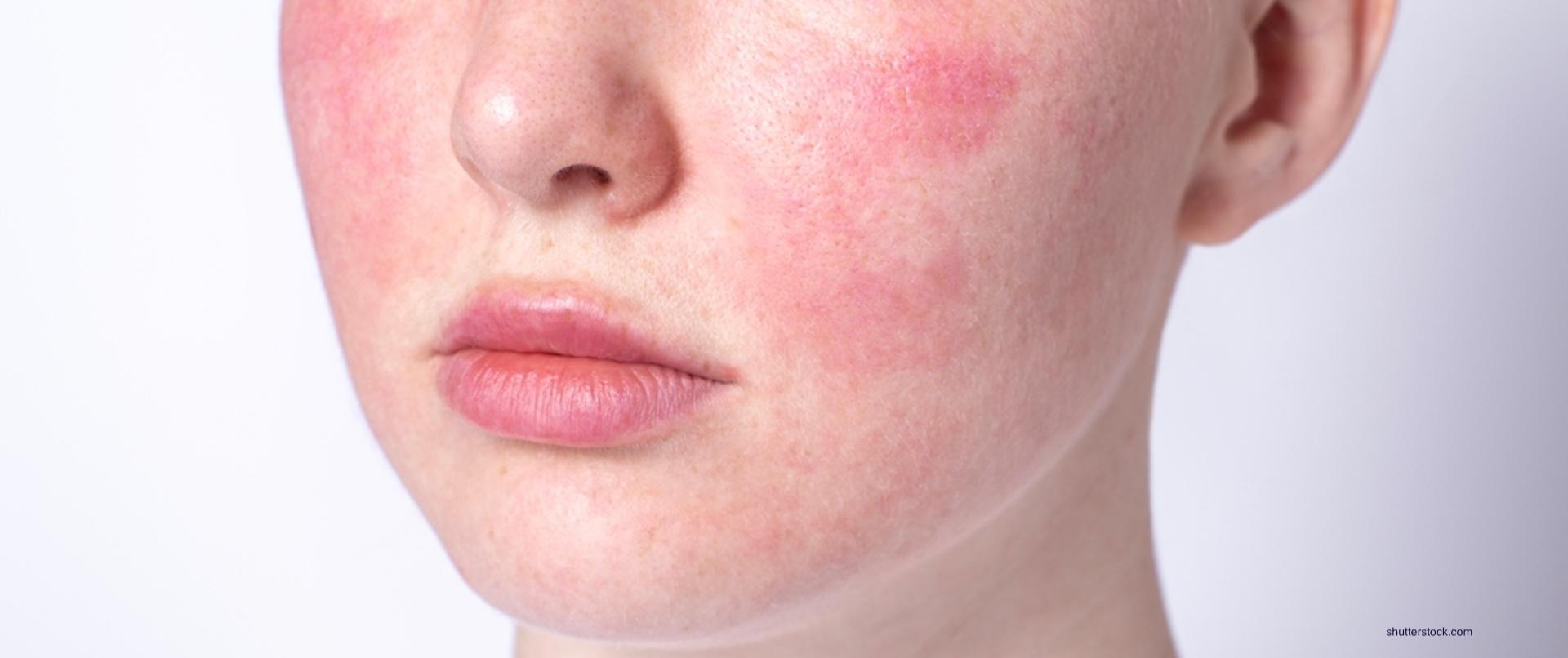 Pielęgnacja skóry z trądzikiem różowatym z produktami Solverx Rosacea